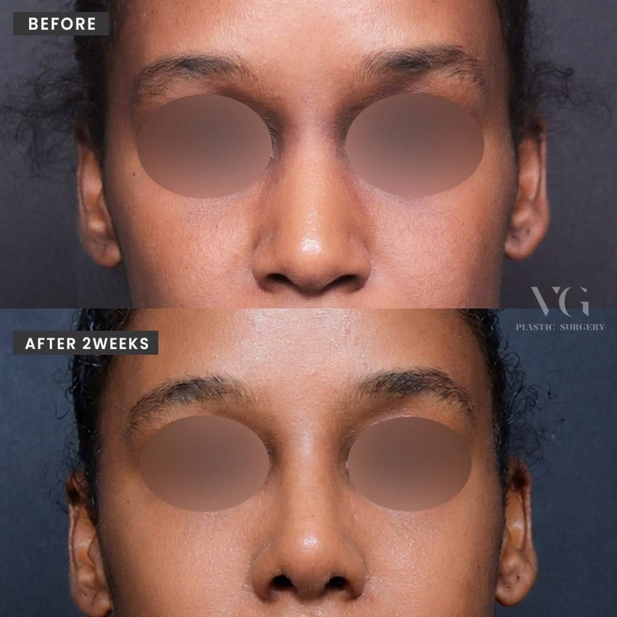 Результаты остеотомии ринопластики до и после в VG Plastic Surgery, улучшена форма носа