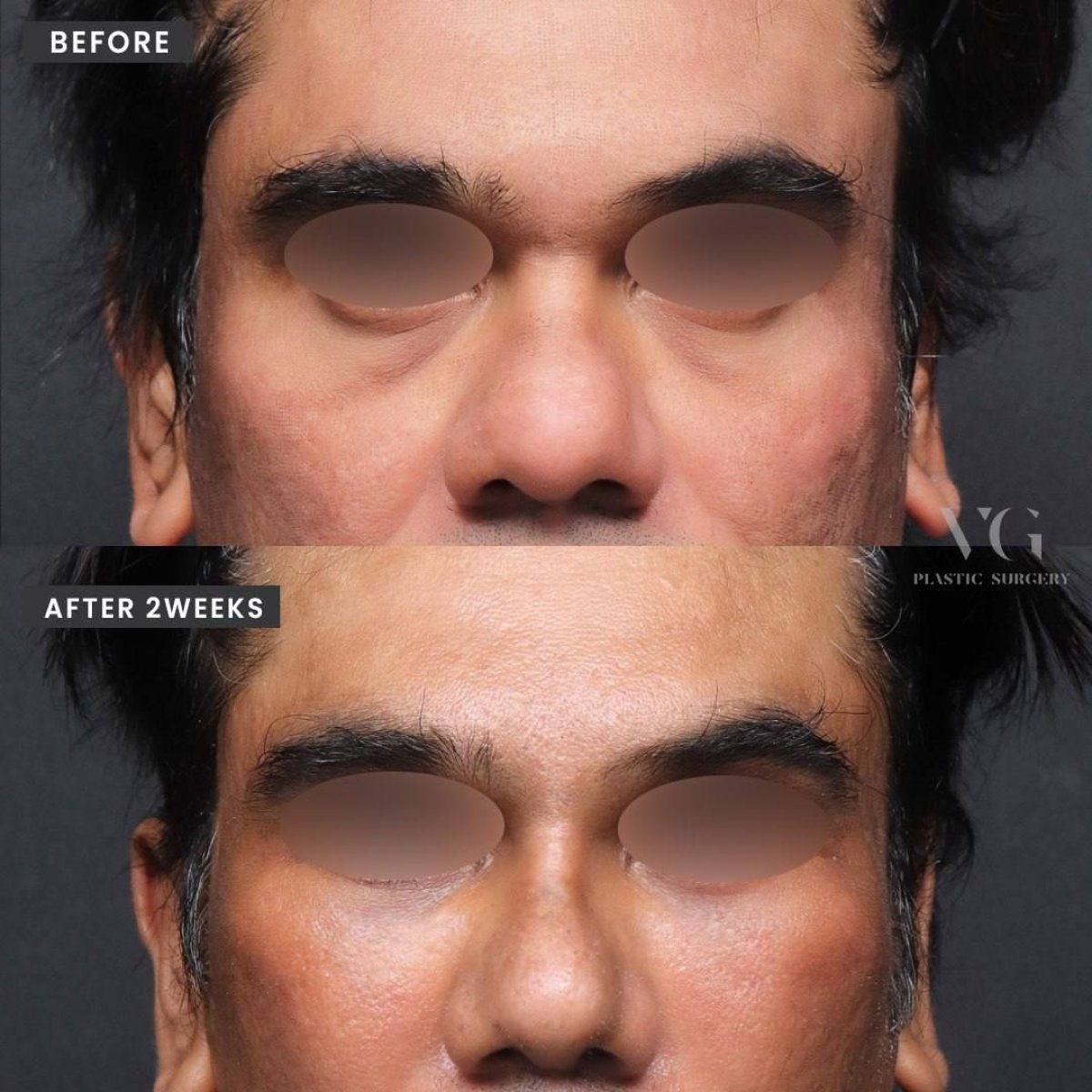 Результаты остеотомии ринопластики до и после в VG Plastic Surgery, улучшена форма носа