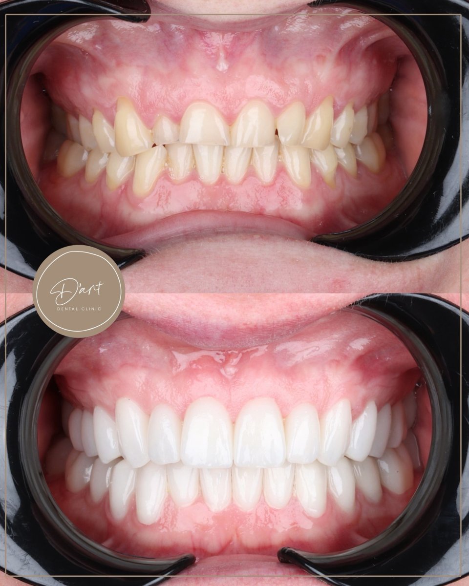 Before and after dental veneers at D'art Dental Clinic – smile transformation results
