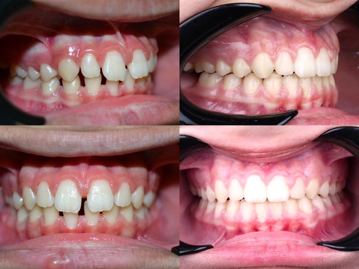 Before and after Invisalign results at D'art Dental Clinic – straighter teeth and improved smile