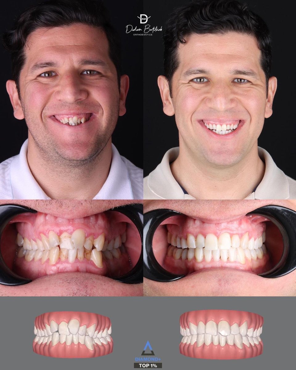 Результати до і після Invisalign у D'art Dental Clinic – вирівнювання зубів та посмішки