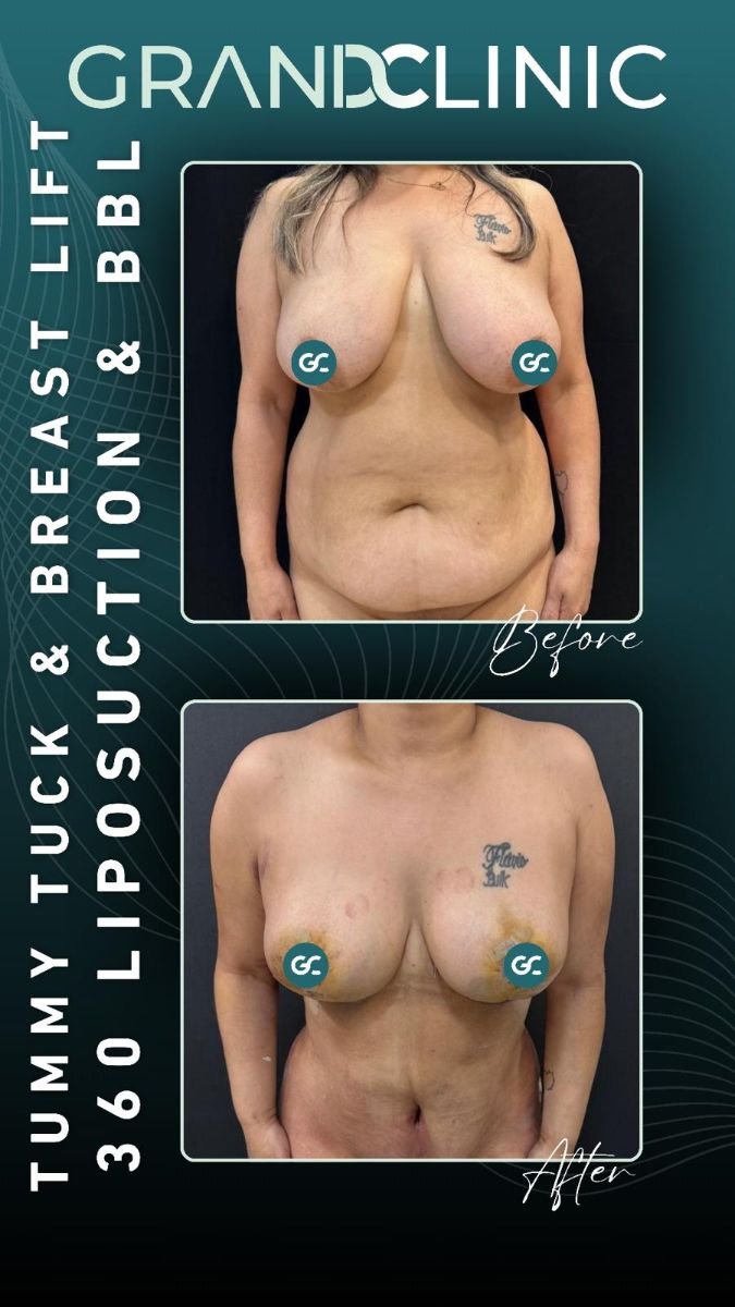 Before and after breast lift and tummy tuck results at Grand Clinic, visible body contouring