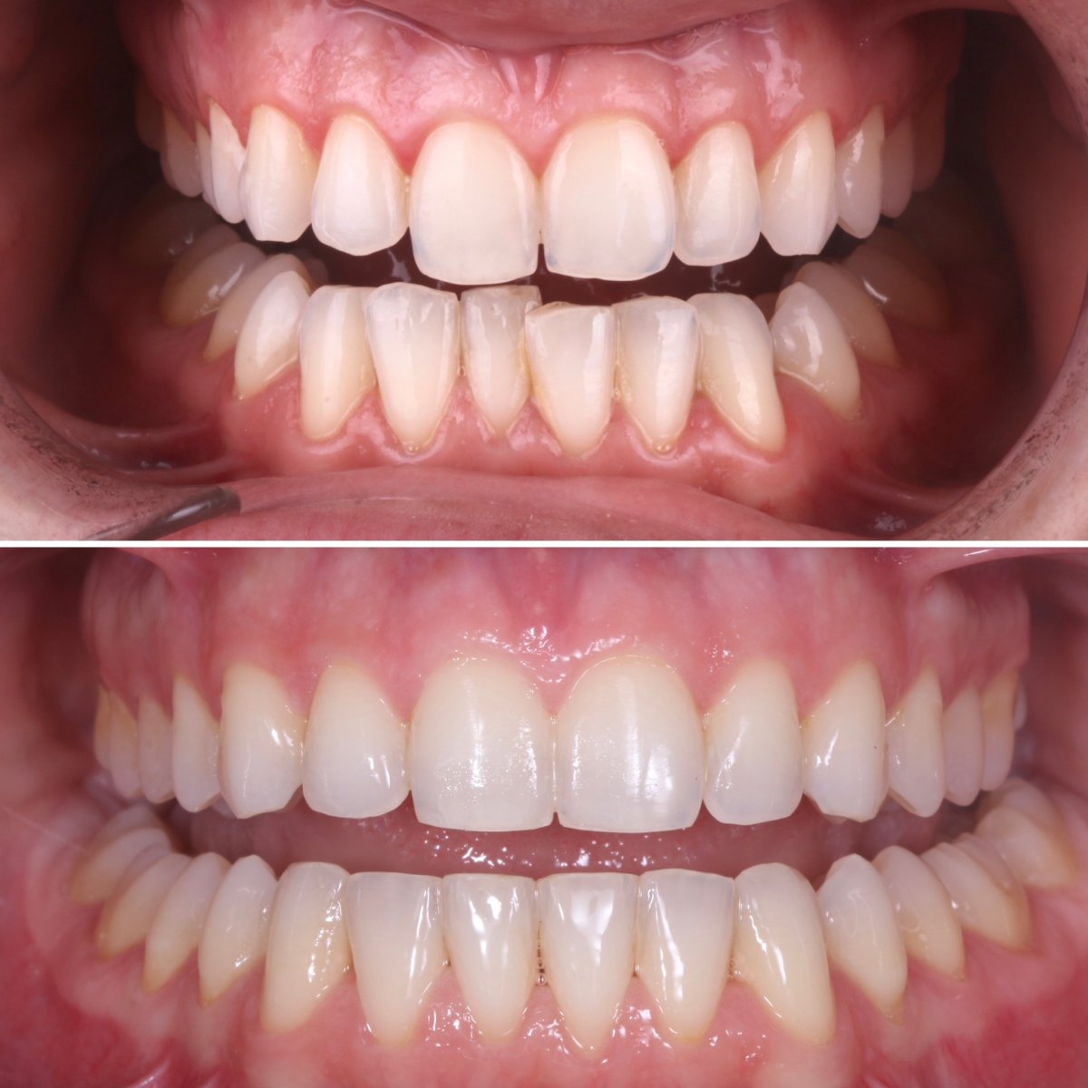 Résultats avant et après appareil dentaire – alignement des dents après orthodontie