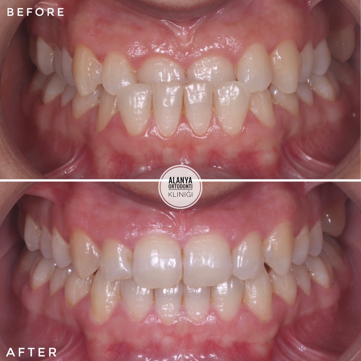 Resultados antes y después de brackets en Alanya Ortodonti Klinigi – dientes alineados