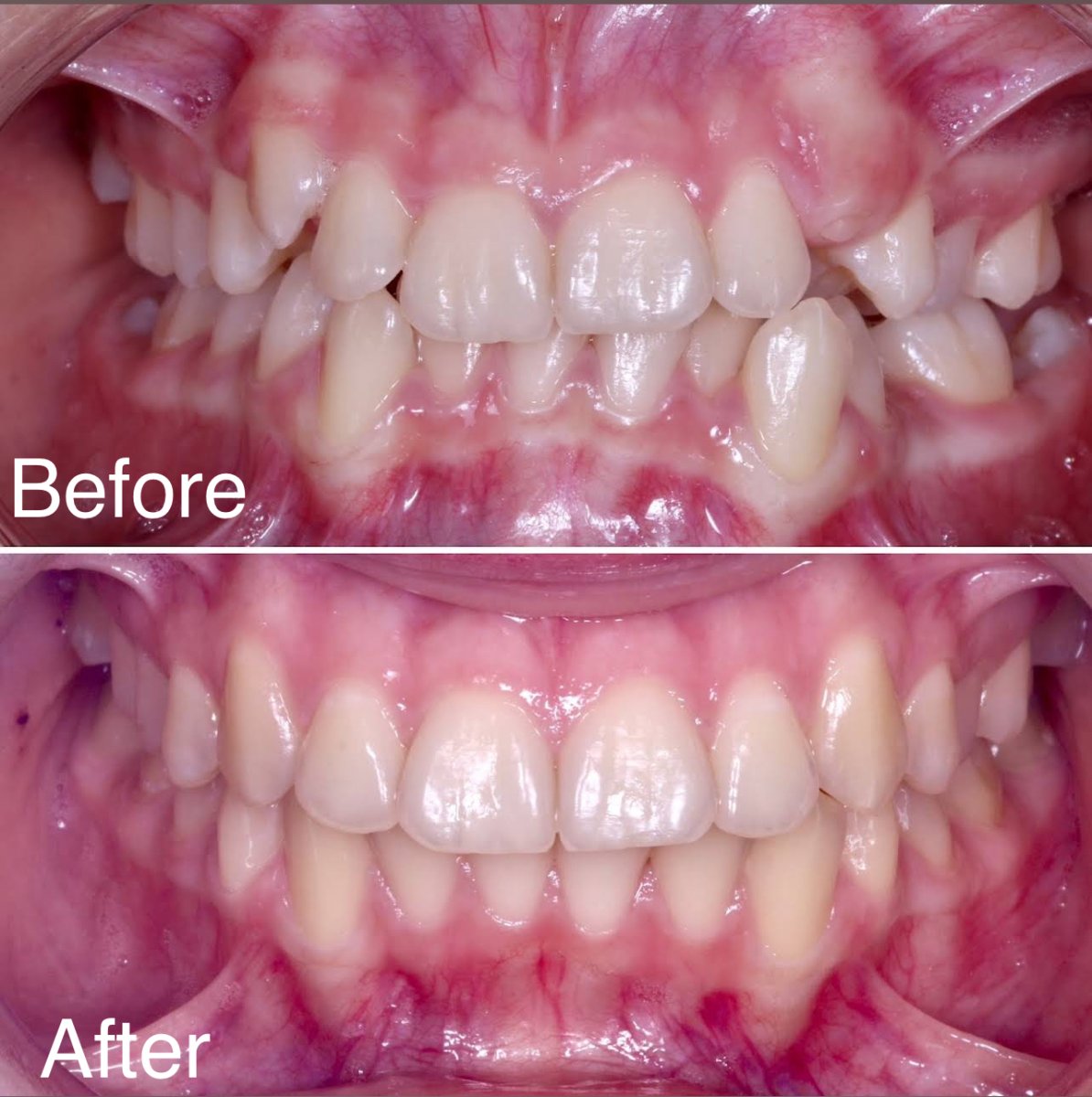 Résultats avant et après appareil dentaire – alignement des dents après orthodontie