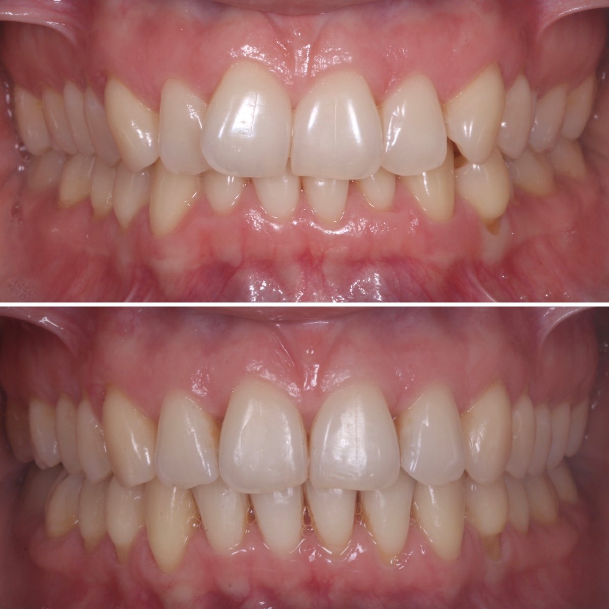 Resultados antes y después de brackets: alineación dental y corrección de mordida