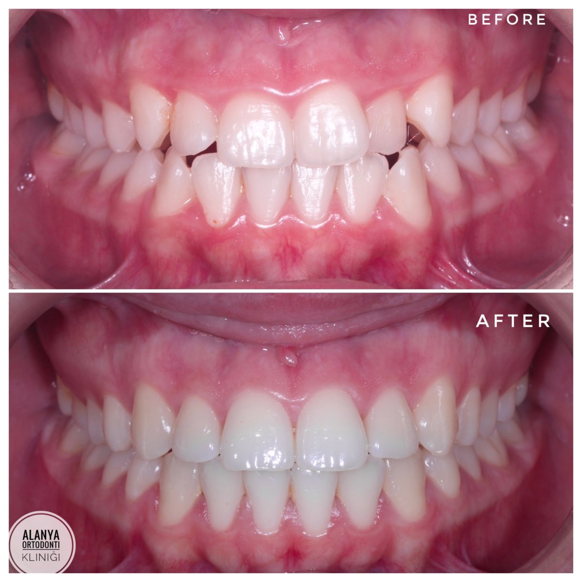 نتائج قبل وبعد تقويم الأسنان في Alanya Orthodontic Clinic – تحسين انتظام الأسنان