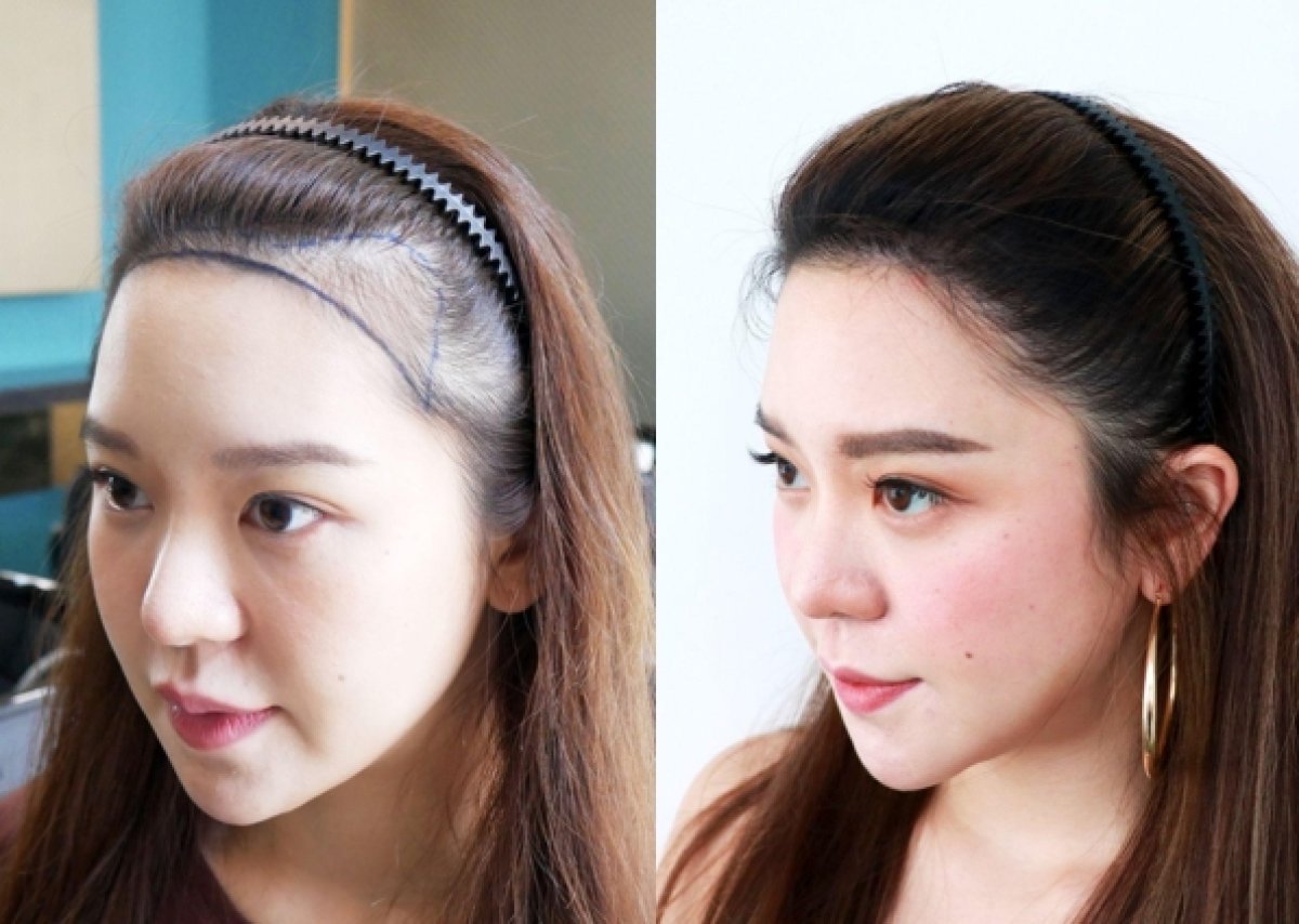 Before and after hair transplant results at Dr.Orn Clinic : Medical Hair, improved hairline