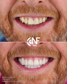 12 Zirconium Crowns for a Natural Hollywood Smile — 4★ Hotel & Digital Smile Design - photo 4