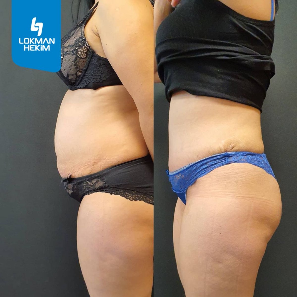 Before and after liposuction results at Lokman Hekim Istanbul Hospital, improved body contour