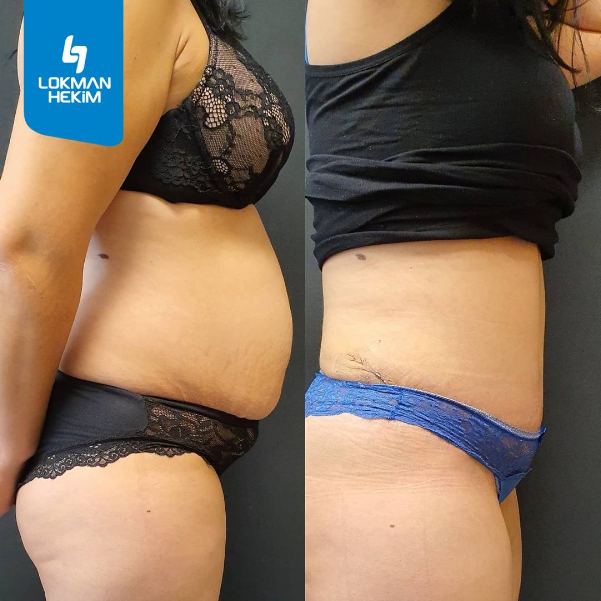 Resultados de liposucción antes y después en Lokman Hekim Istanbul Hospital, abdomen más delgado