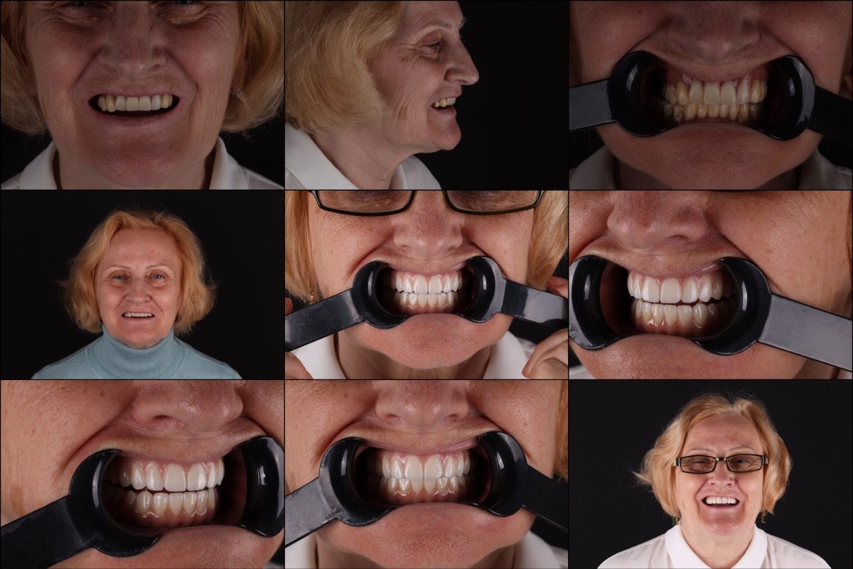 Before and after All-on-6 dental implants result at RIKOTA Dental Clinic, improved smile
