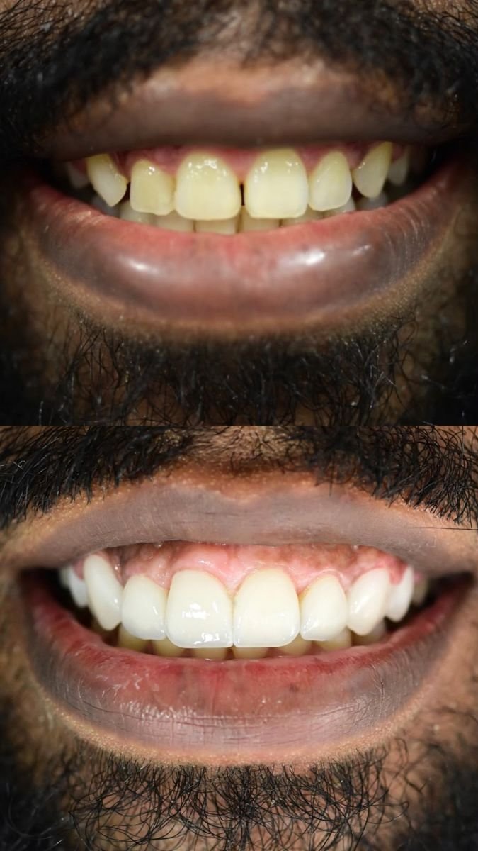Before and after smile makeover results at Punta cana dentist odontologia familiar, whiter teeth