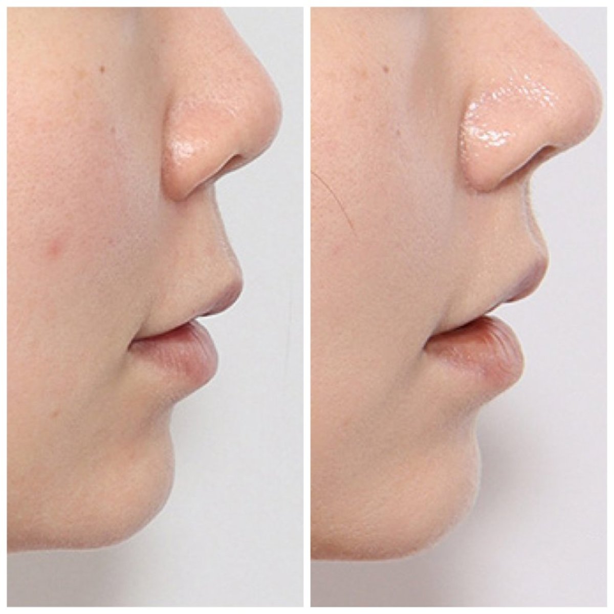 نتائج تجميل الأنف قبل وبعد في Retmus Plastic Surgery، تحسين شكل الأنف الجانبي