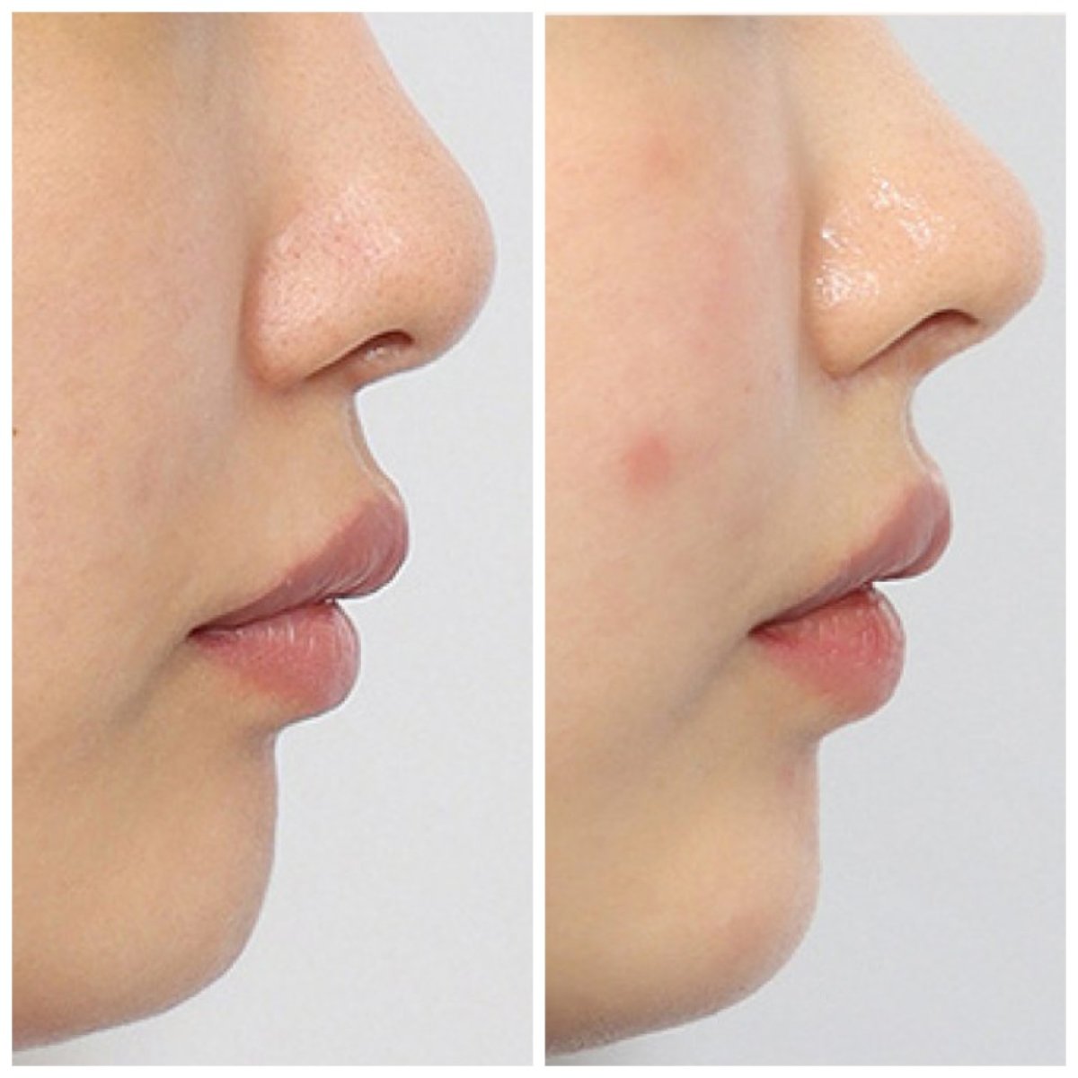 Vorher-nachher-Ergebnisse der Nasenkorrektur bei Retmus Plastic Surgery, verbesserte Nase