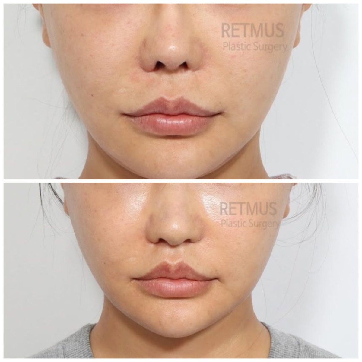 نتائج قبل وبعد عملية تجميل الأنف التصحيحية في Retmus Plastic Surgery، تحسين شكل الأنف