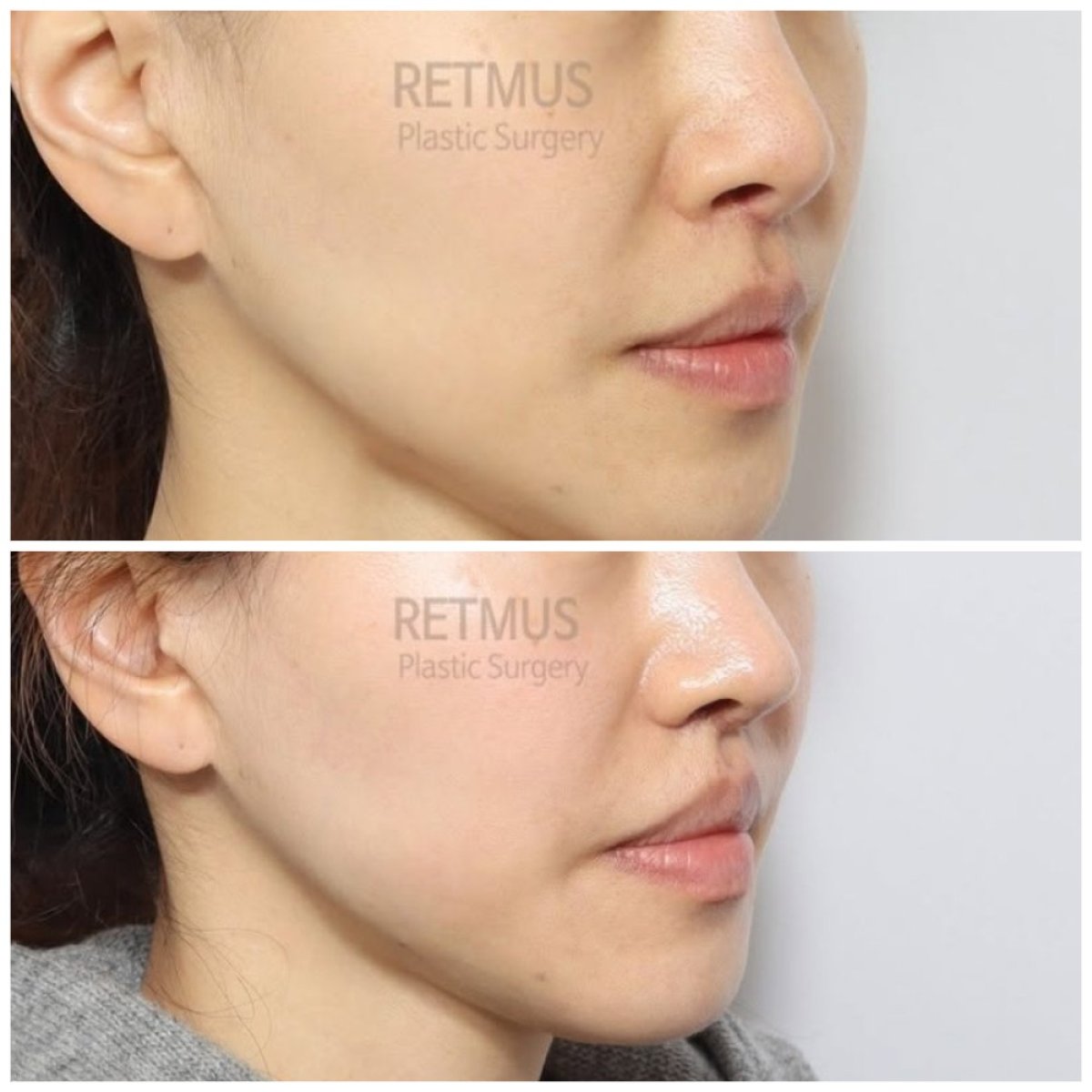 نتائج قبل وبعد عملية تجميل الأنف التصحيحية في Retmus Plastic Surgery، تحسين شكل الأنف