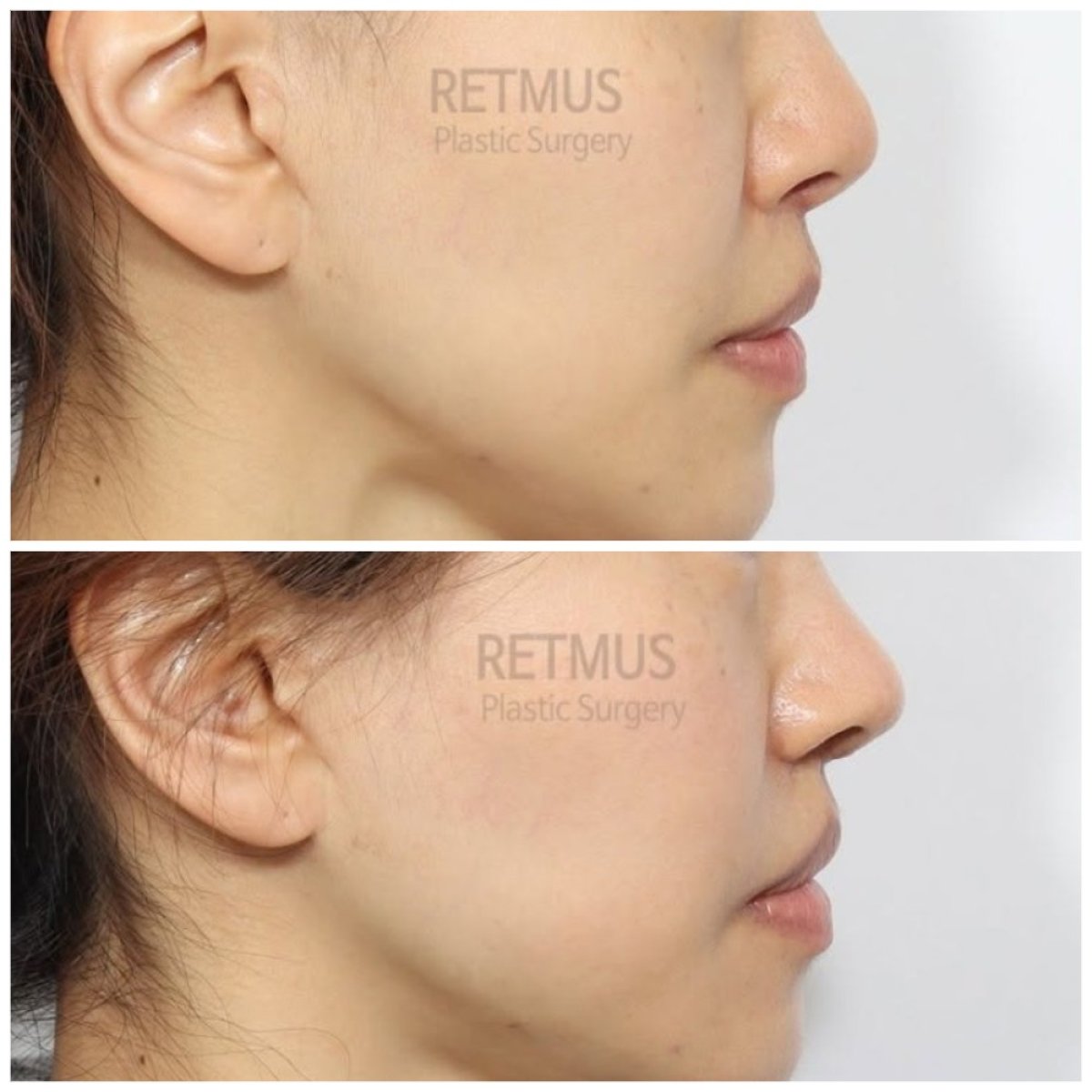 Efekty przed i po rewizyjnej rynoplastyce w Retmus Plastic Surgery, poprawiony profil nosa