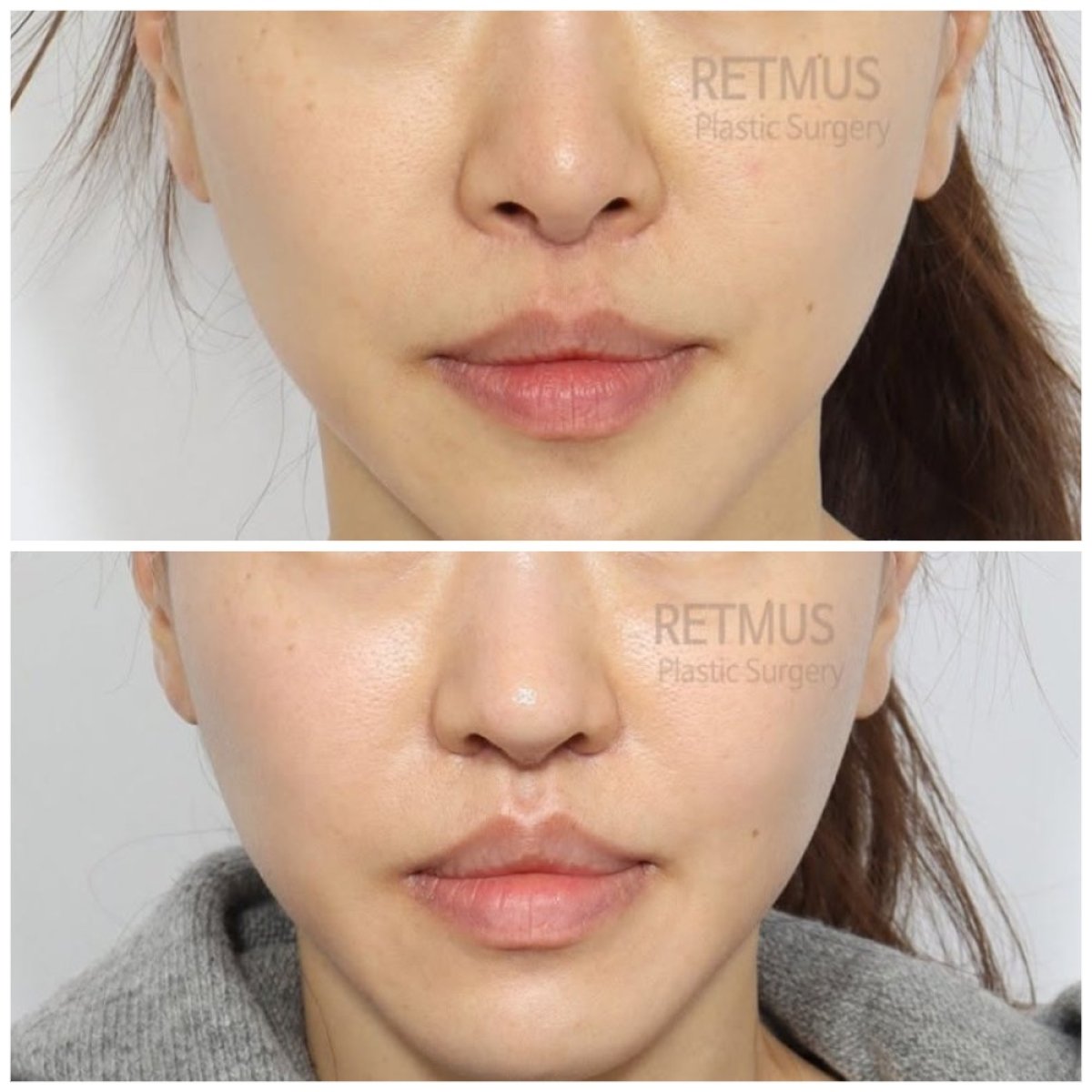 نتائج قبل وبعد عملية تجميل الأنف التصحيحية في Retmus Plastic Surgery، تحسين شكل الأنف