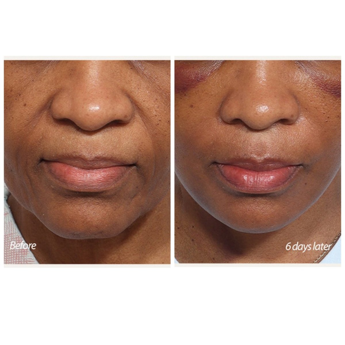 Facelift before and after results at Retmus Plastic Surgery, visible facial rejuvenation in 6 days