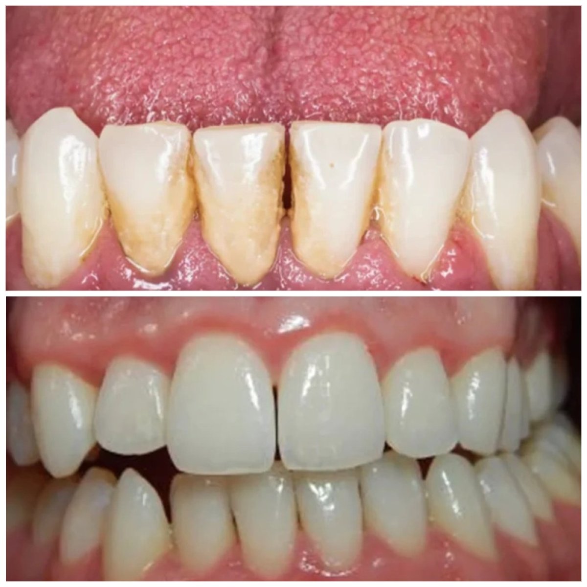 Before and after teeth cleaning (scaling) results at Dream International Clinic, whiter smile