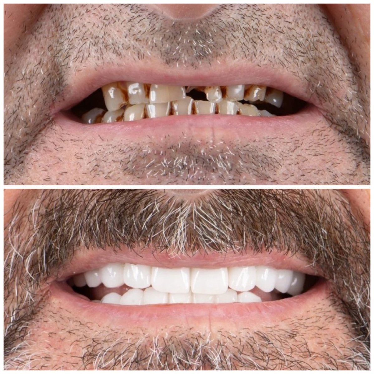 Результат до и после установки виниров в Uncali Dental Clinic – преображение улыбки и белые зубы