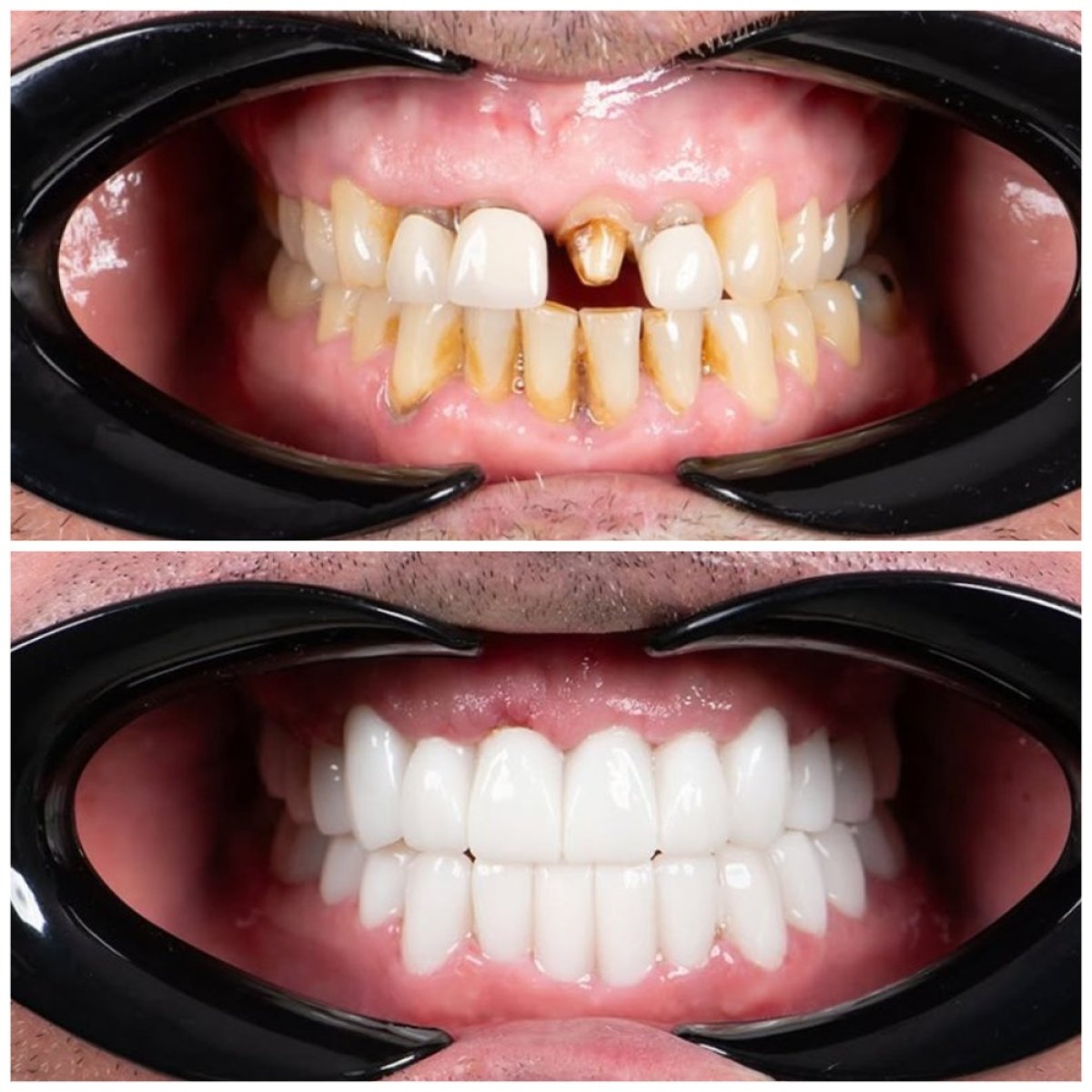 Avant et après facettes dentaires à Uncali Dental Clinic – sourire transformé et dents blanches