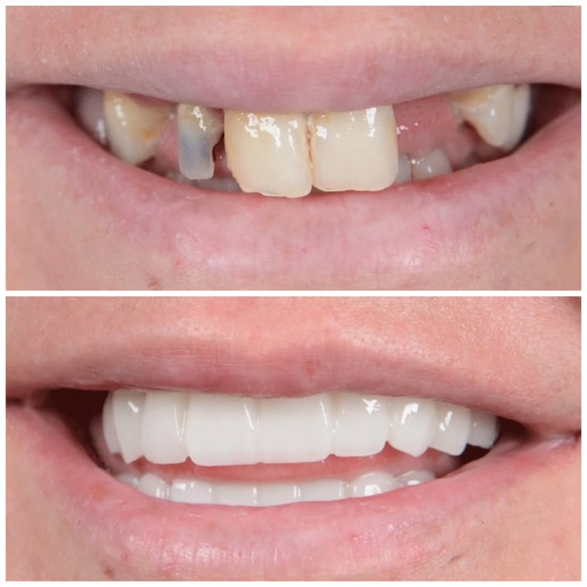 Avant/après facettes dentaires à Uncali Dental Clinic – sourire transformé, résultat naturel