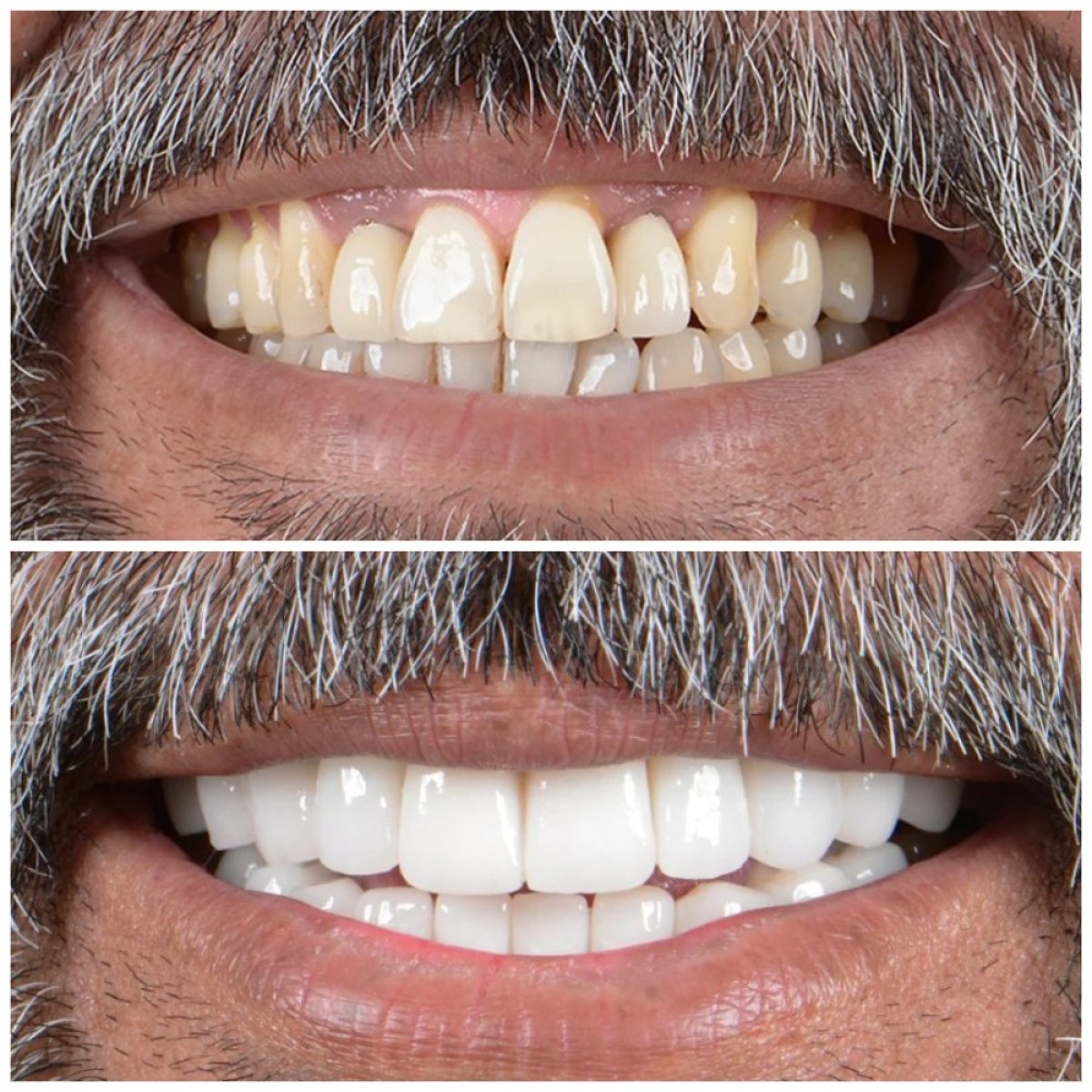 Before and after tooth whitening results at Uncali Dental Clinic, brighter smile transformation