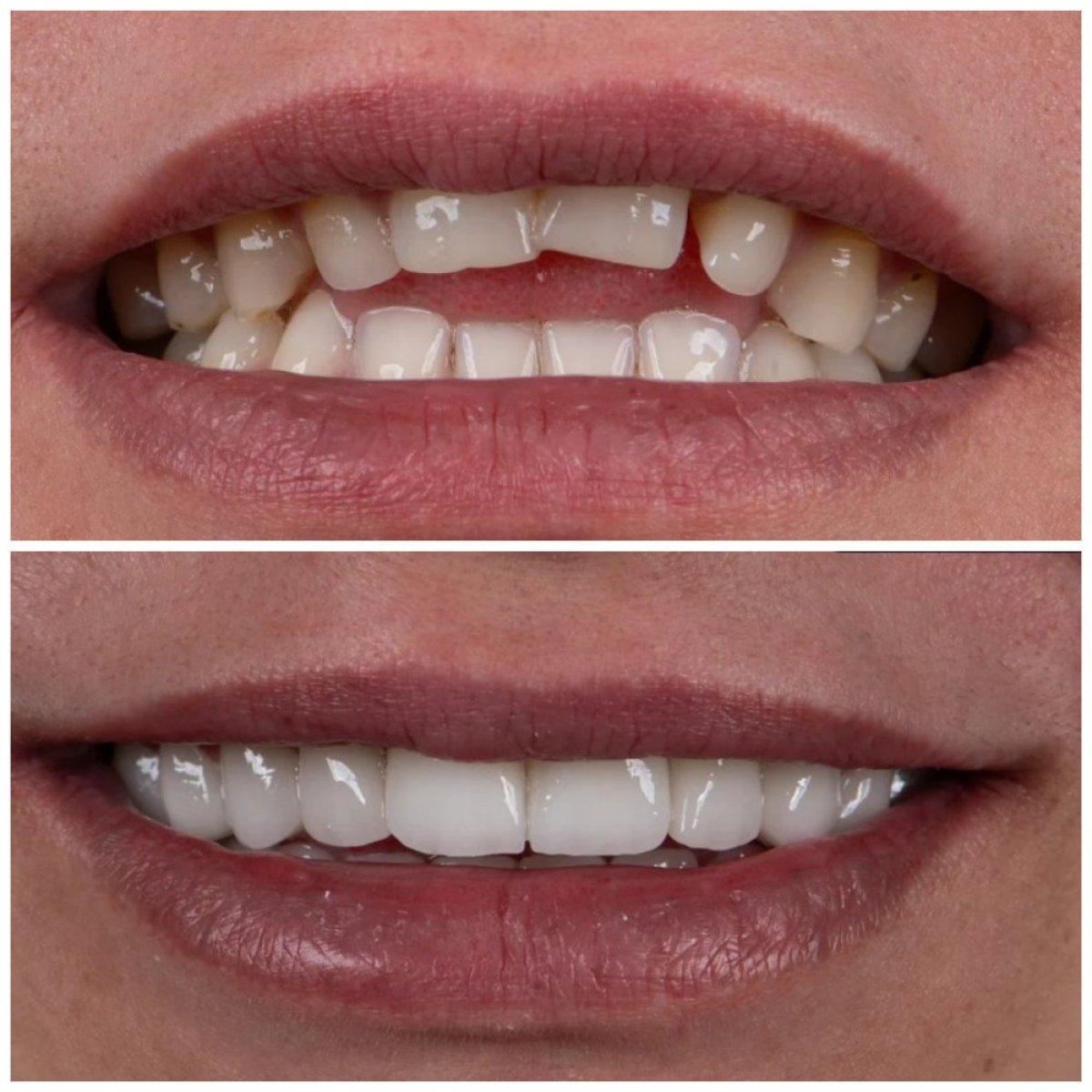 Before and after tooth whitening results at Uncali Dental Clinic, visibly brighter smile