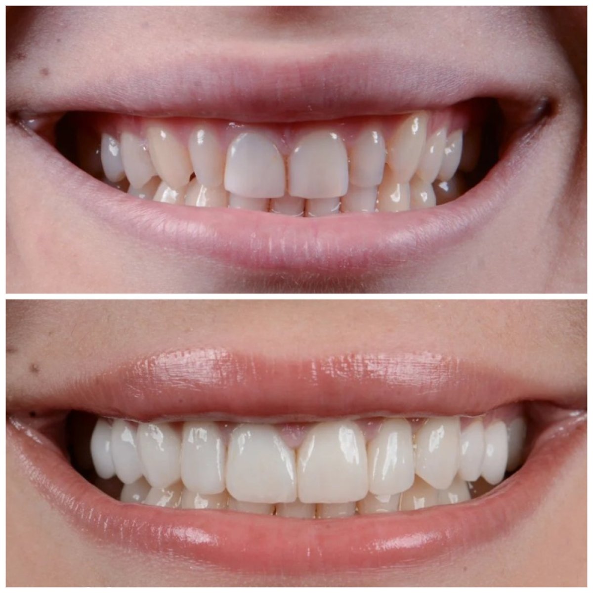 Результати до і після відбілювання зубів в Uncali Dental Clinic – помітно біліша усмішка