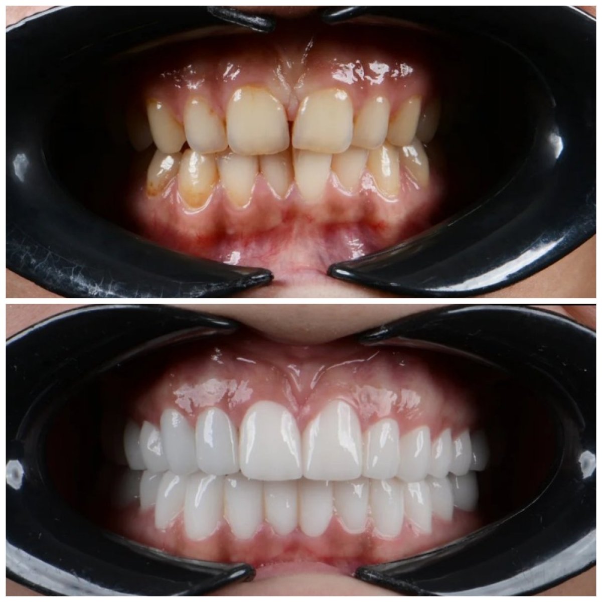 Resultados de blanqueamiento dental antes y después en Uncali Dental Clinic – sonrisa más blanca