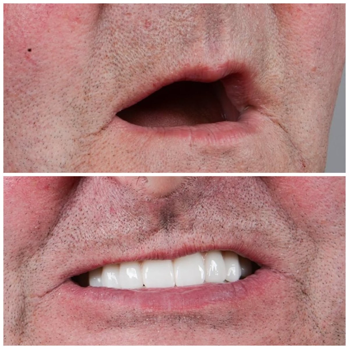 Before and after result of full-arch zirconia implant dentures at Uncali Dental Clinic