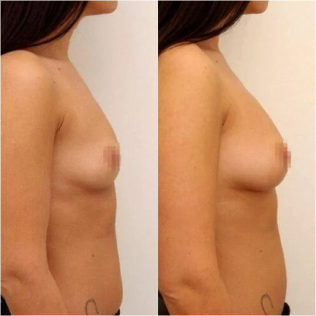 Before and after breast augmentation with tear drop implants at Clinicus Klaipeda, visible result