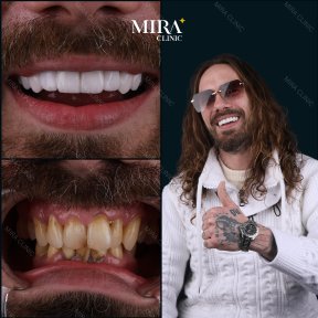24 Zirconia crown installation Procedure - photo 4