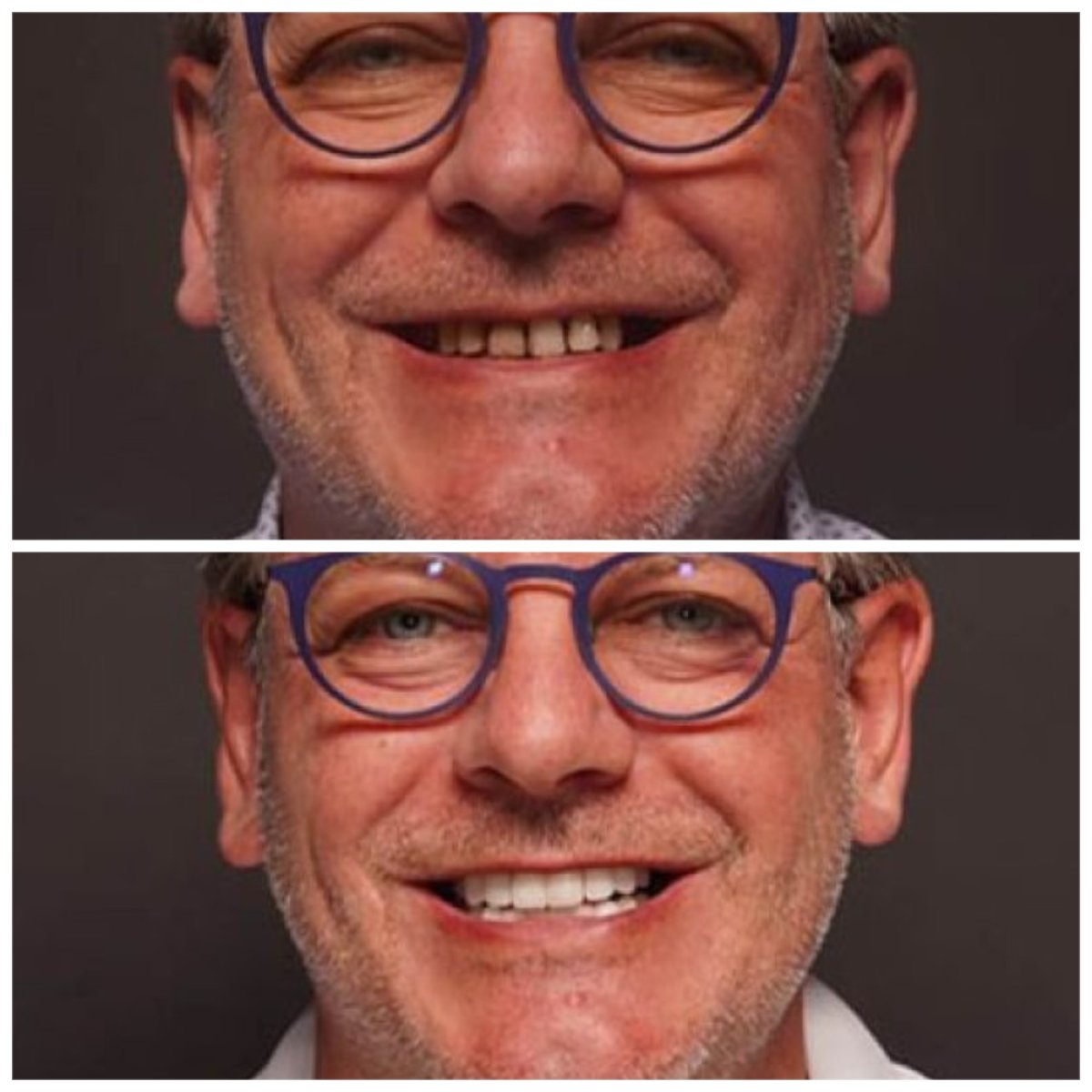 Resultados de antes y después de smile makeover en Baron Dental Clinic, estética dental mejorada
