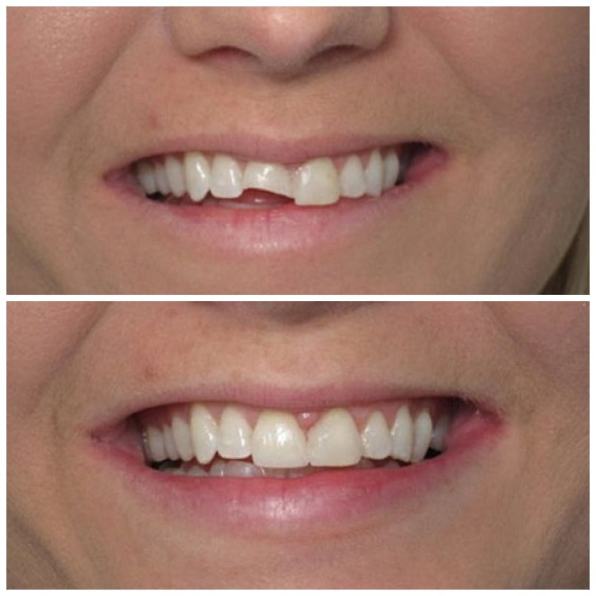 До и после улыбки после восстановления скола зуба в Baron Dental Clinic