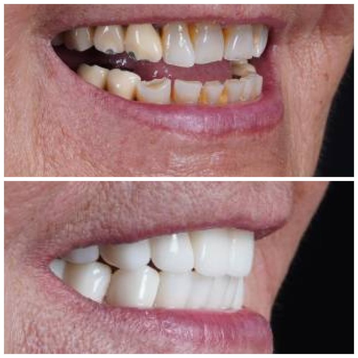 Resultados de antes y después de smile makeover en Baron Dental Clinic: alineación y color mejorados