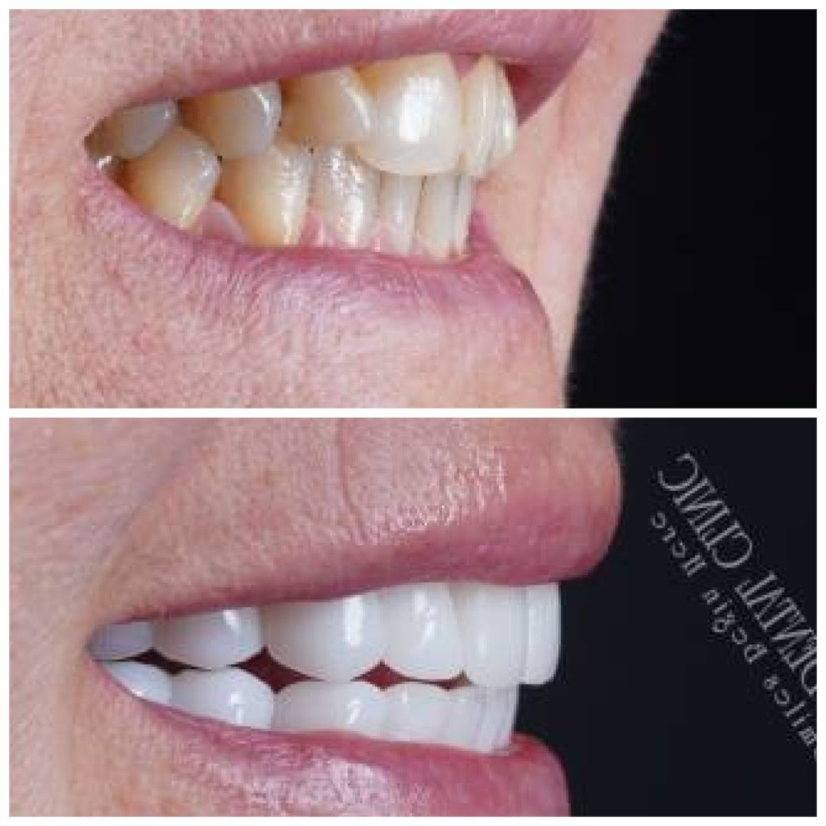 Smile makeover before and after results at Baron Dental Clinic – whiter, straighter teeth