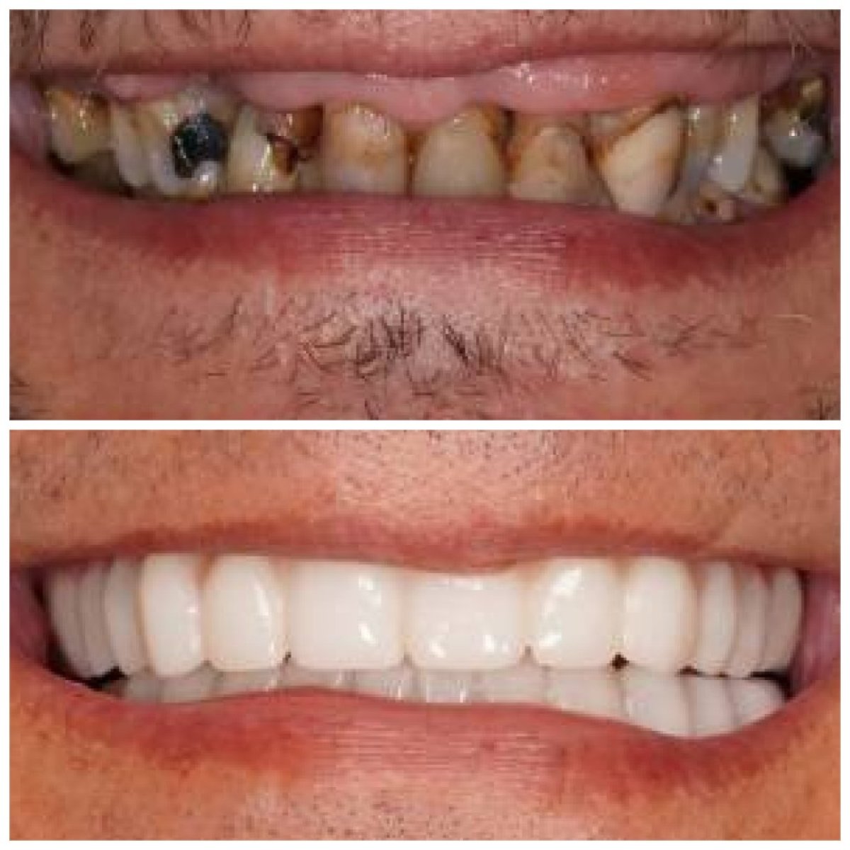 Результаты восстановления зубов (бондинг) до и после в Baron Dental Clinic, улучшенная улыбка