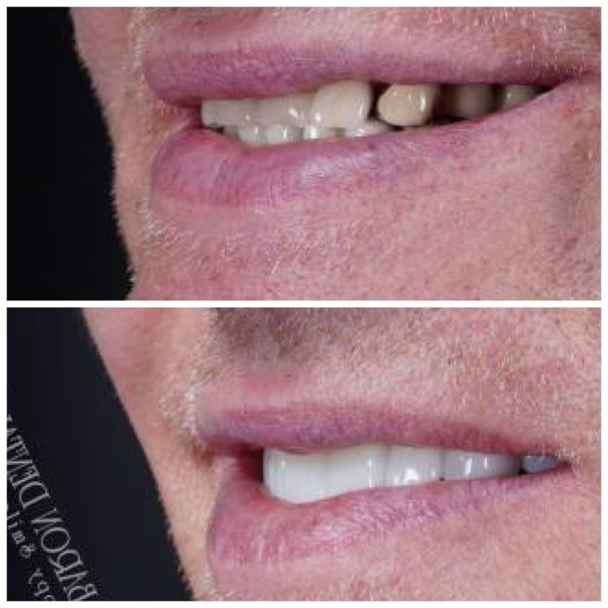 Résultat avant/après facettes dentaires minimal prep chez Baron Dental Clinic, sourire amélioré