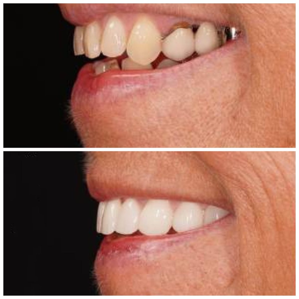 Результат до и после установки виниров minimal prep в Baron Dental Clinic, улучшение улыбки