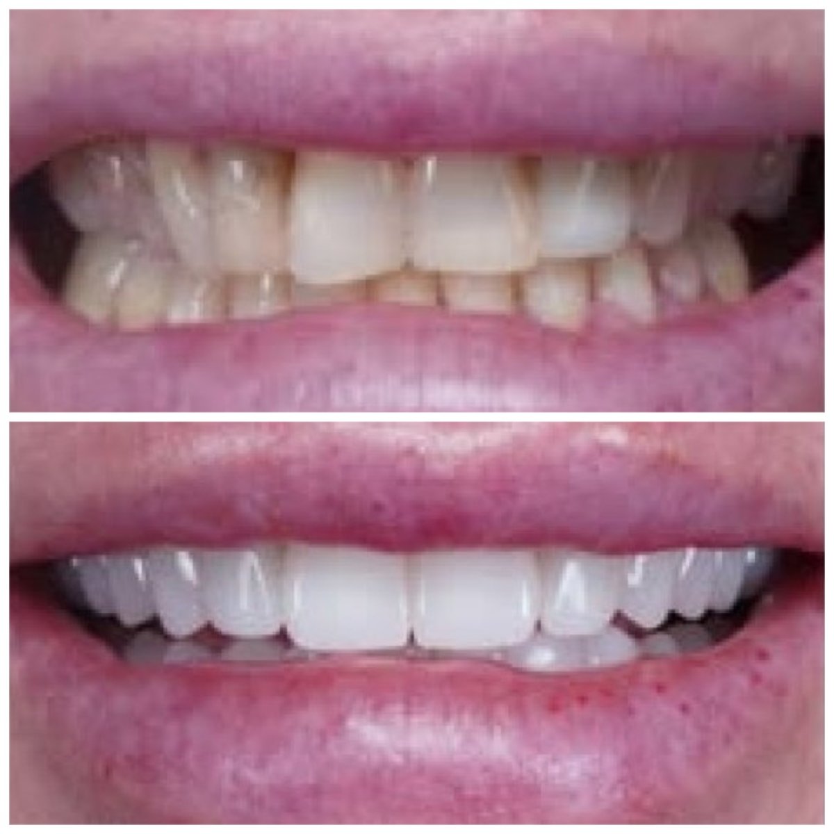 Результаты до и после установки циркониевых коронок в Baron Dental Clinic, улучшенная улыбка