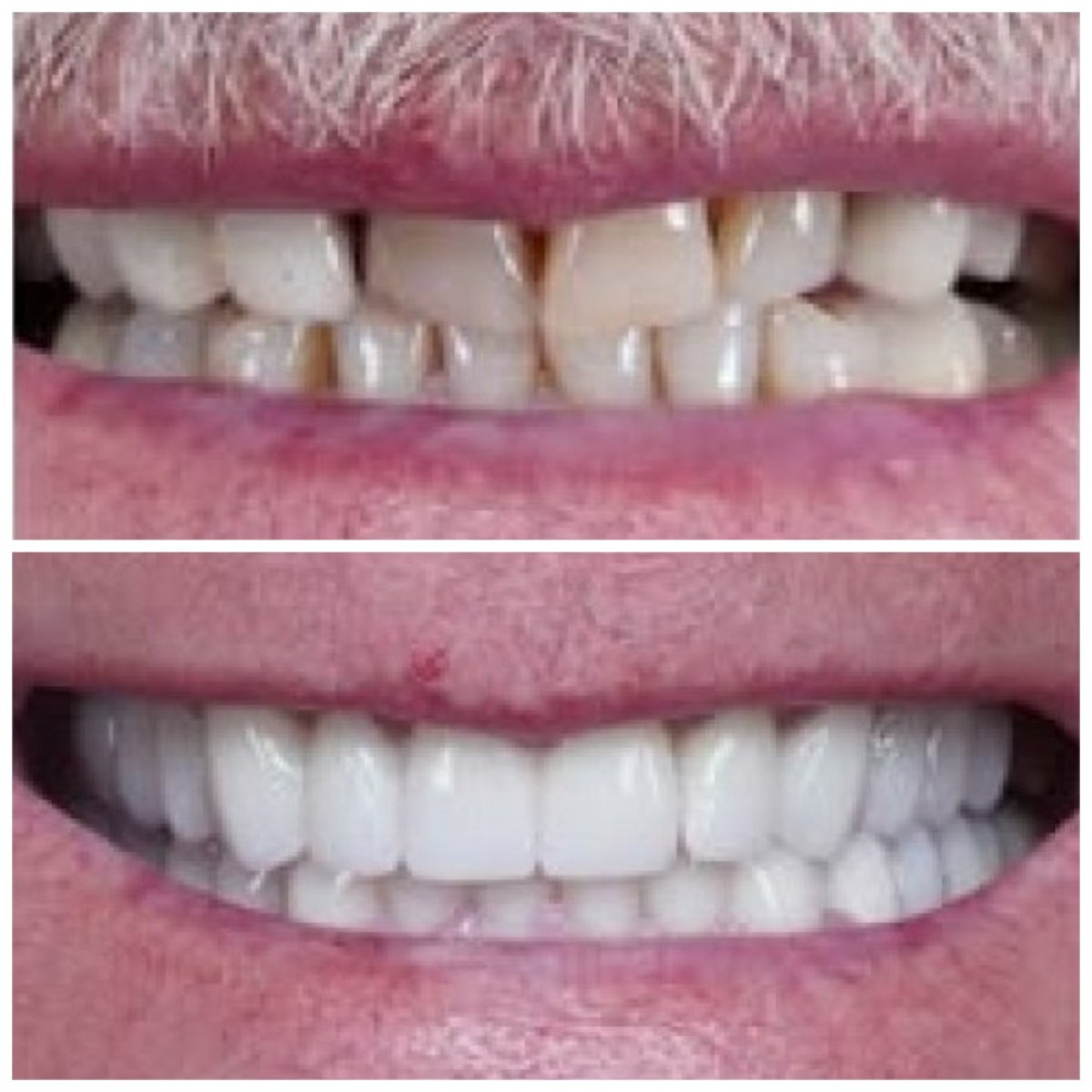 Résultats avant et après pose de couronnes zircone à Baron Dental Clinic, sourire amélioré