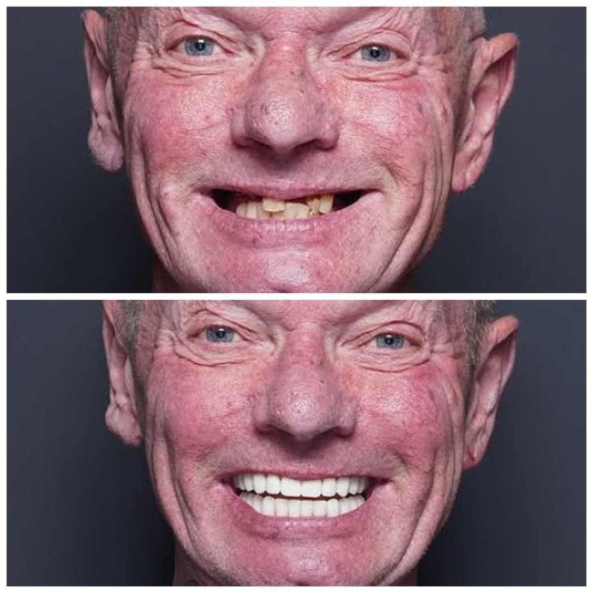 Before and after dental prosthetics installation results at Baron Dental Clinic, improved smile