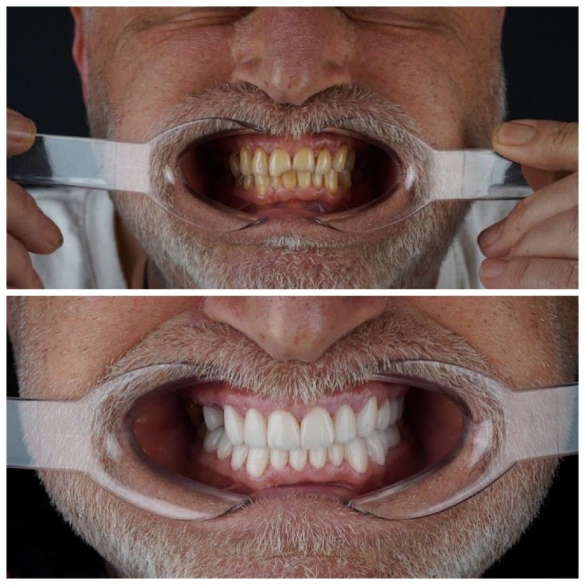 Efekty przed i po Hollywood Smile w denthouse Istanbul – metamorfoza licówkami