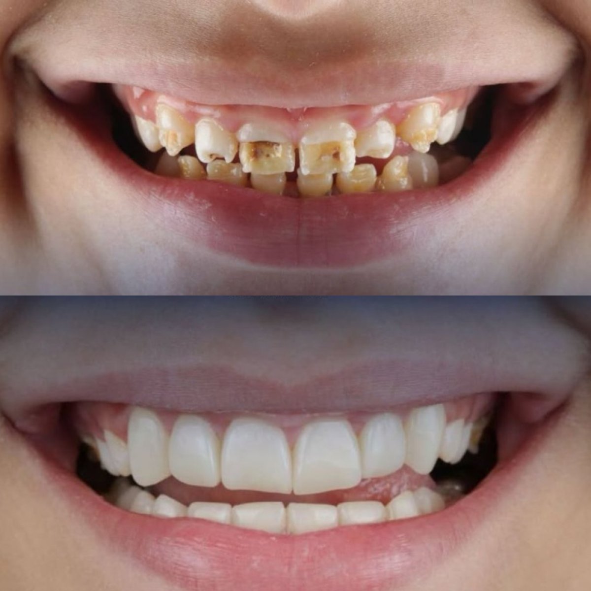 Before and after Emax veneers at Sunrise Dental Clinic – smile makeover with natural results