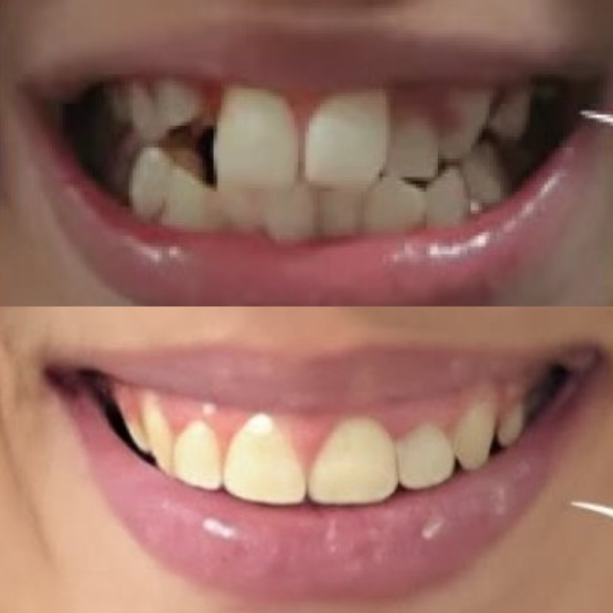Résultats avant et après Invisalign à Sunrise Dental Clinic – dents alignées et sourire amélioré