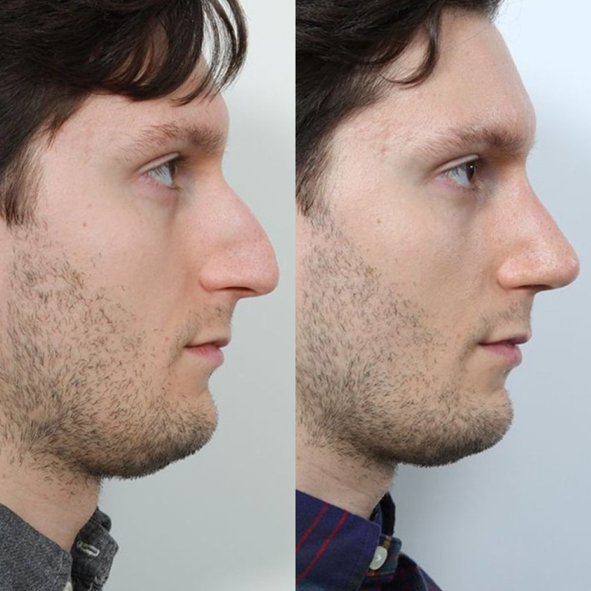 Before and after liquid rhinoplasty result at Op. Dr. Evren Ay Koç, non-surgical nose reshaping