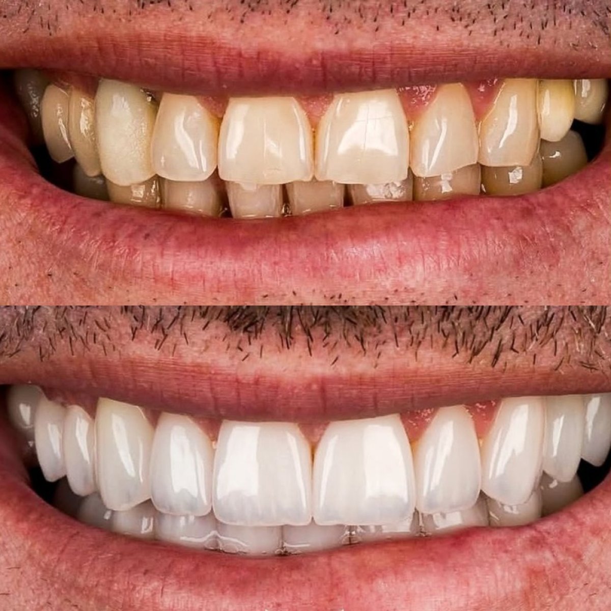 Porcelain veneer before and after results at Alar Dent - Oral and Dental Health Clinic, smile makeover